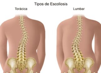 Como Ponerte En Forma Si Tienes Escoliosis